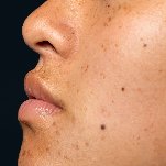 best pimple treatment in bangalore